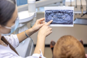 Kiedy implanty nie wystarczą? Rola augmentacji kości w leczeniu implantologicznym